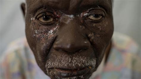 One Extraordinary Photo: A picture captures the mpox health .